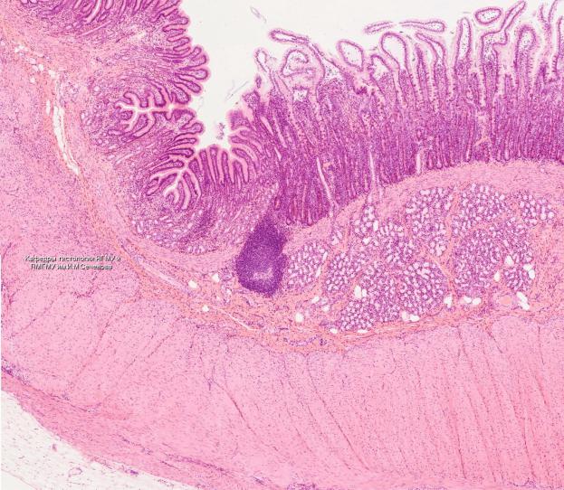 Переход из желудка в 12-перстную кишку